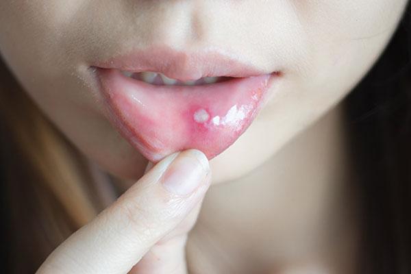 Afty jamy ustnej – przyczyny, objawy, leczenie