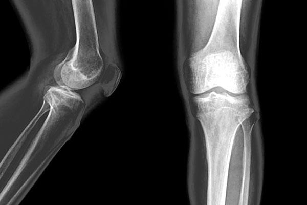 Care tratează artroza și osteoporoza