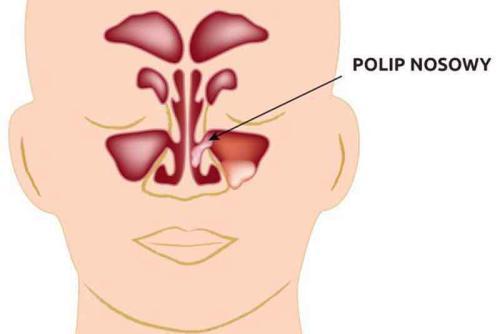 Przeszkoda w nosie – polipy