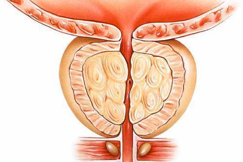 prostata problem z oddawaniem moczu