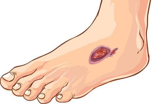 Zespół stopy cukrzycowej: rodzaje, objawy