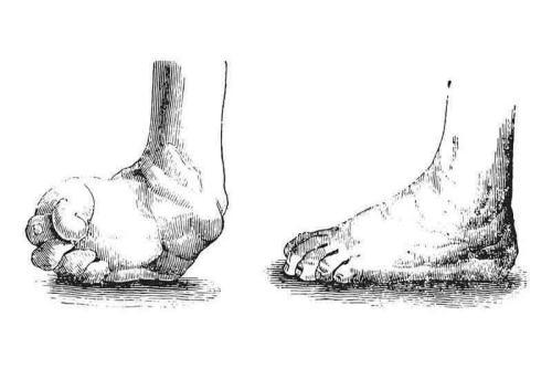 Stopa końsko-szpotawa, czyli wada wrodzona stóp