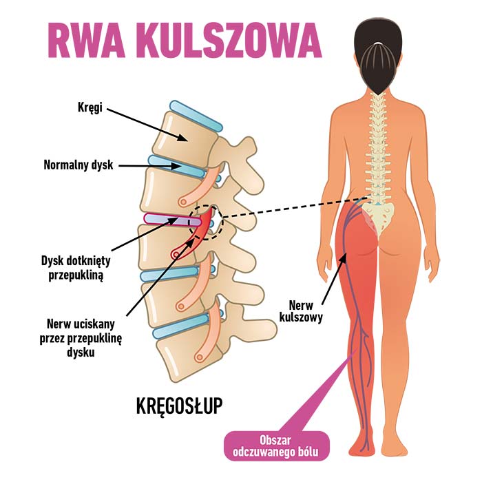 Rwa kulszowa