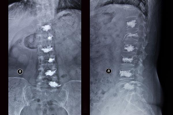 Wertebroplastyka, czyli cementowanie kręgosłupa