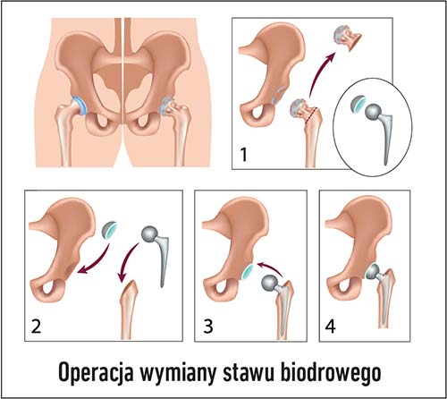 wymiana staw biodrowy