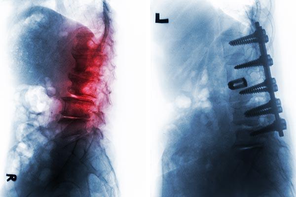 Zapalenie kręgosłupa – przyczyny, przebieg choroby, leczenie