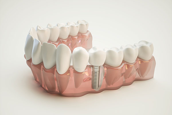 Implant zębowy