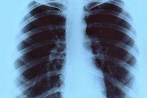 Rak płuca – przyczyny, rodzaje, objawy, badania, leczenie