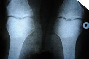 Artroza – choroba zwyrodnieniowa stawów