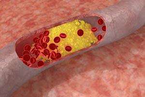 Wysoki poziom cholesterolu to większe ryzyko raka piersi