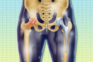 Zabieg endoprotezoplastyki stawu biodrowego