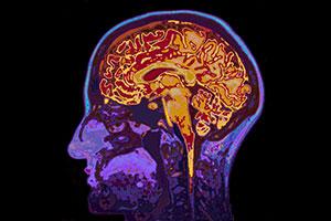 Ropień mózgu – przyczyny powstawania i leczenie