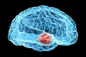 Choroba Parkinsona