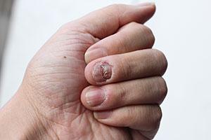 Zmiany chorobowe paznokci