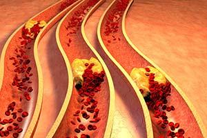 Wysoki poziom cholesterolu już u 30-latków zwiększa ryzyko choroby serca w przyszłości