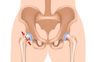 Złamanie stawu biodrowego