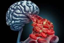 Malformacja tętniczo-żylna mózgu – objawy, rozpoznanie, leczenie