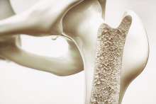 Osteoporoza jest chorobą dla reumatologa