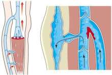 Zakrzepica żył głębokich i powierzchownych – zagrożenia, leczenie, profilaktyka