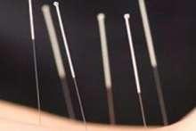 Akupunktura zwalczy lęk przed wizytą u dentysty?