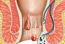 Hemoroidy i choroba hemoroidalna – rozpoznanie, leczenie, profilaktyka