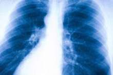 Przewlekła obturacyjna choroba płuc