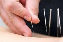 Akupunktura: leczenie igłami