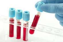 Ogólne badanie krwi – co oznaczają skróty badań laboratoryjnych