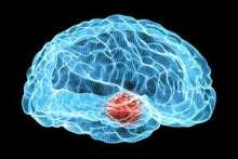 Choroba Parkinsona