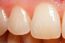 Zgrzytanie zębami  – choroba okluzyjna i bruksizm